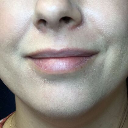 Cosmetic Injectables & Fillers*: Case 47 Lip Filler - Before