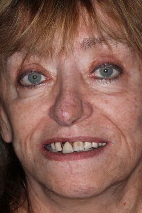 Teeth In A Day Case 30 - Before