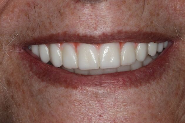 Teeth In A Day: Case 30 - After