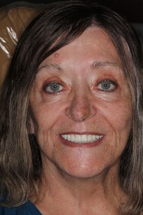 Teeth In A Day Case 30 - After