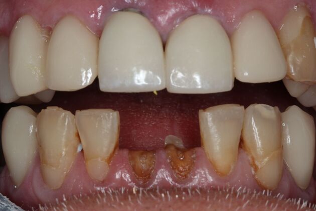 Teeth In A Day Case 29 - Before