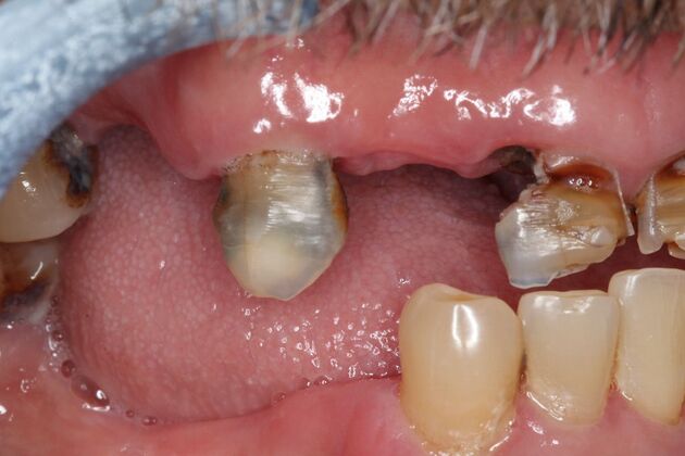 Teeth In A Day: Case 31 - Before