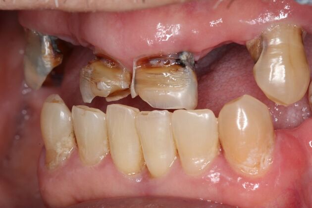 Teeth In A Day: Case 31 - Before
