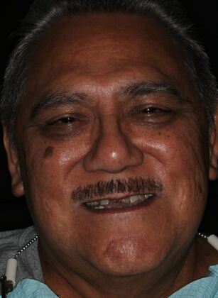 Teeth In A Day Case 31 - Before