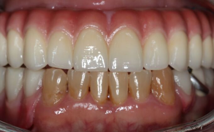 Teeth In A Day: Case 31 - Upper all on 4 and lower Partial Denture