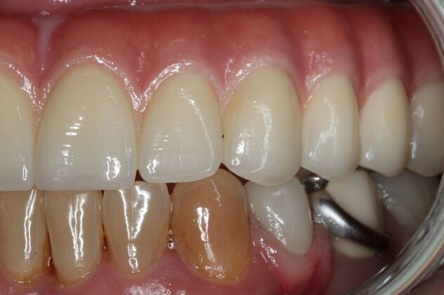 Teeth In A Day: Case 31 - After