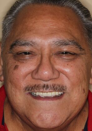 Teeth In A Day Case 31 - After