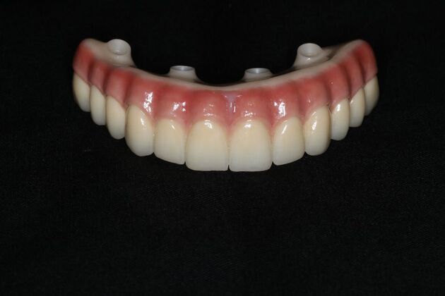 Teeth In A Day: Case 31 - Upper Zirconia All on 4
