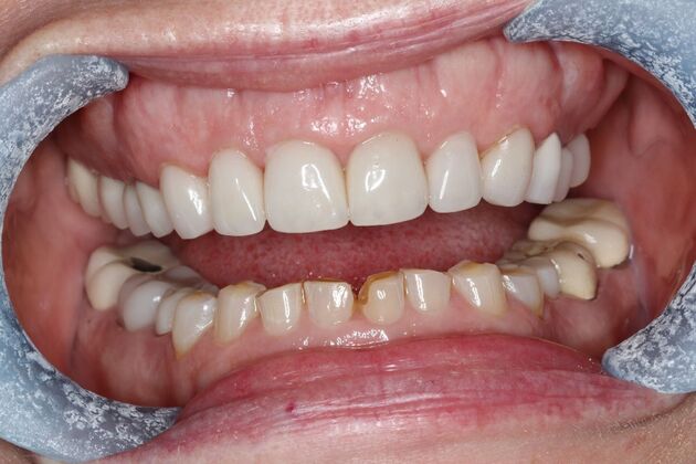Veneers: Case 34 - Before