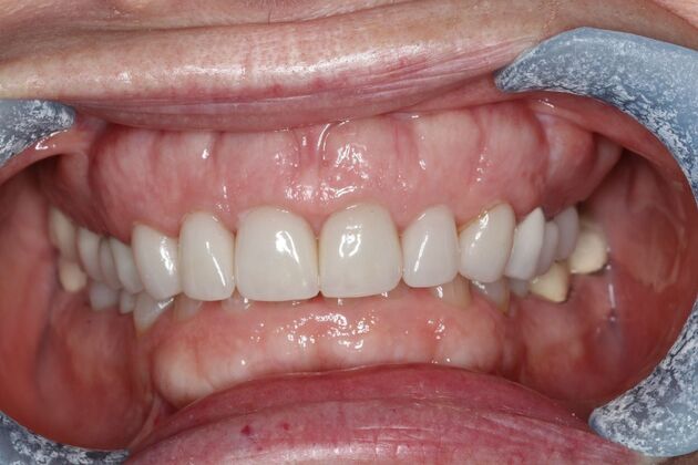Veneers Case 34 - Before
