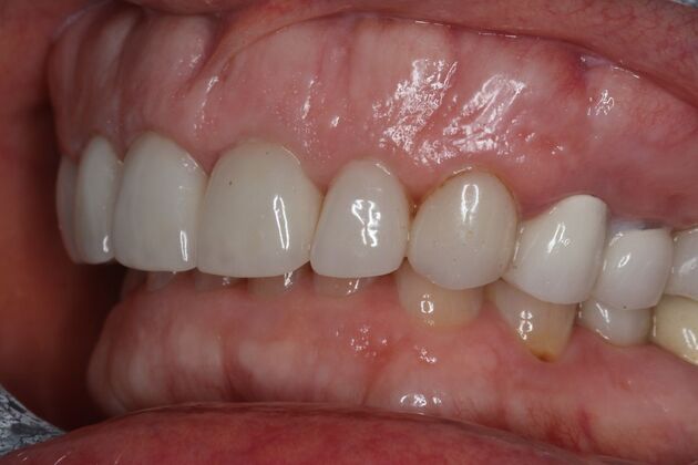 Veneers: Case 34 - Before