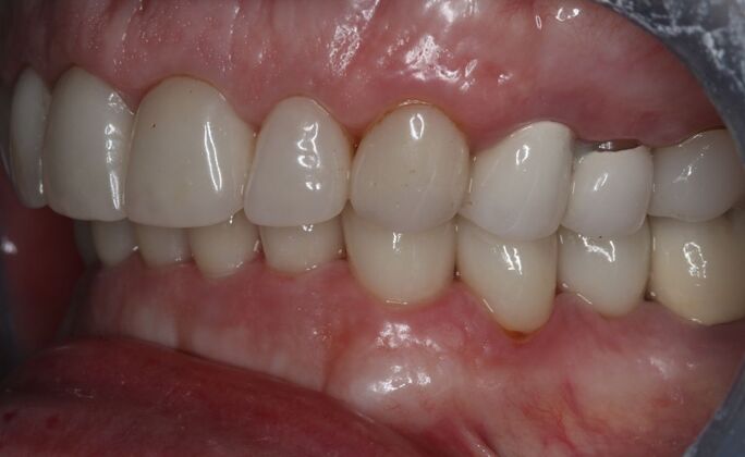 Veneers: Case 34 - After