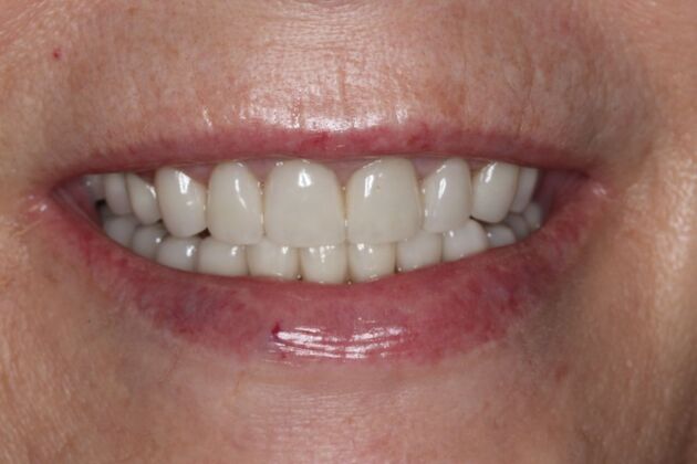 Veneers Case 34 - After