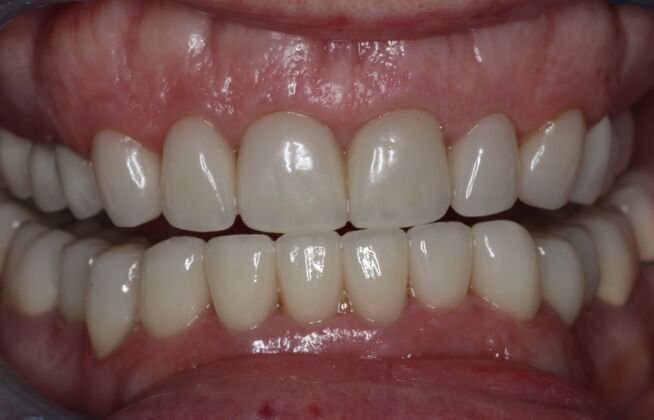 Veneers: Case 34 - After