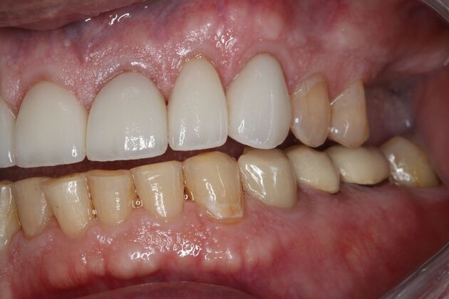 Full Mouth Reconstruction: Case 11 - Before