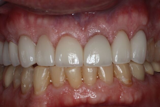 Full Mouth Reconstruction Case 11 - After