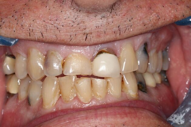 Full Mouth Reconstruction Case 11 - Before