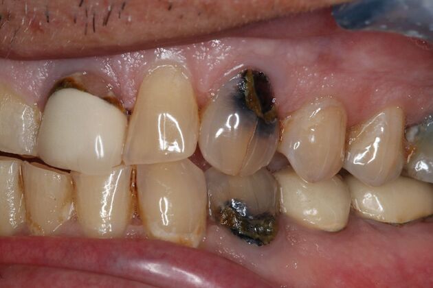 Full Mouth Reconstruction: Case 11 - After