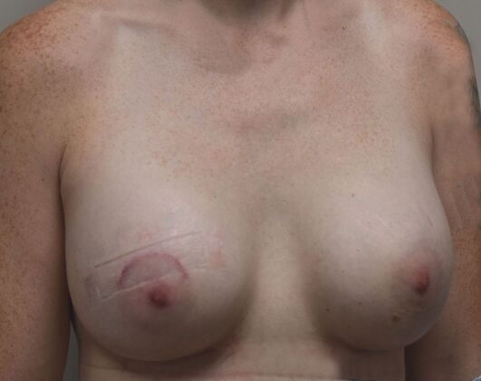 Breast Augmentation: Case 734 - After