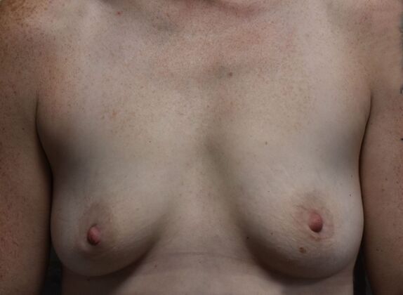Breast Augmentation Case 734 - Before
