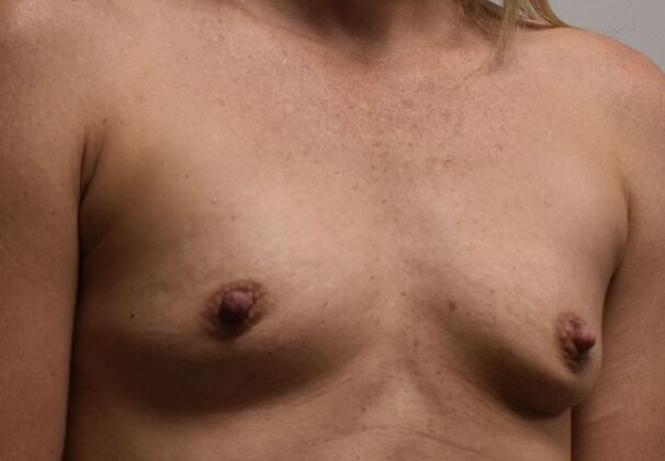 Breast Augmentation: Case 736 - Before
