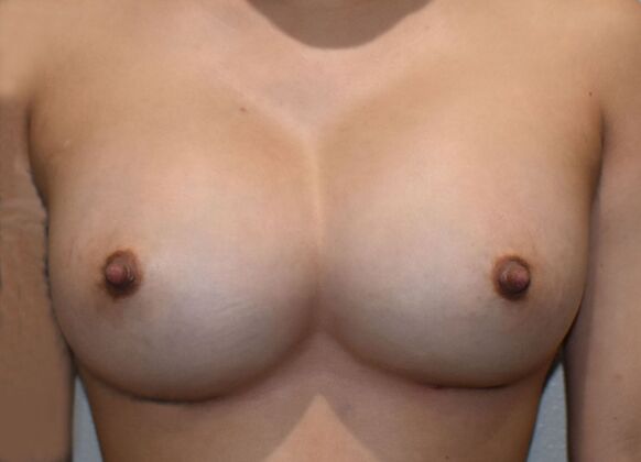 Breast Augmentation Case 738 - After