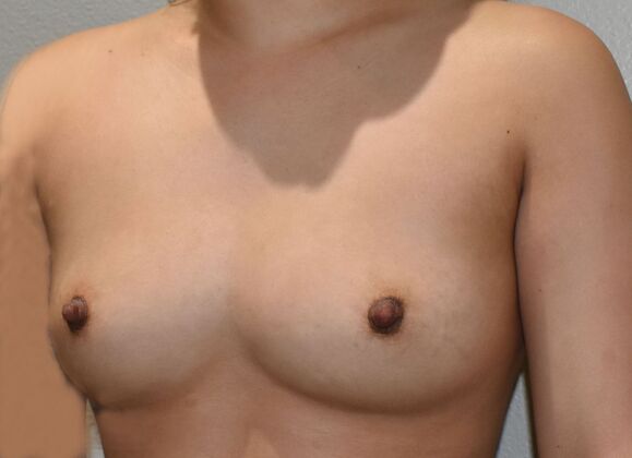 Breast Augmentation: Case 738 - Before