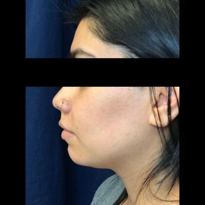 Cosmetic Injectables & Fillers*: Case 44 Chin Filler - Before