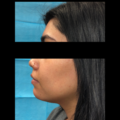 Cosmetic Injectables & Fillers*: Case 44 Chin Filler - After