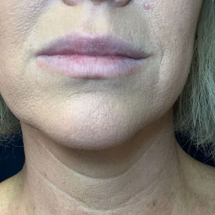 Cosmetic Injectables & Fillers*: Case 41 Lip Filler - Before