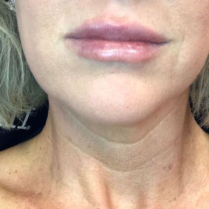 Cosmetic Injectables & Fillers*: Case 41 Lip Filler - After