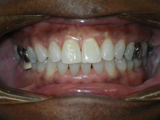 Invisalign: Case 16 - Before