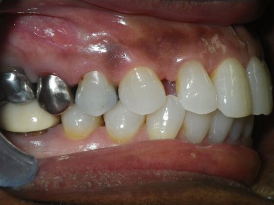 Invisalign: Case 16 - Before