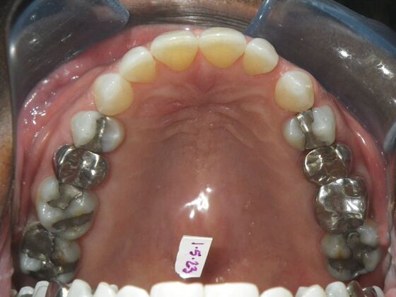 Invisalign: Case 16 - Before