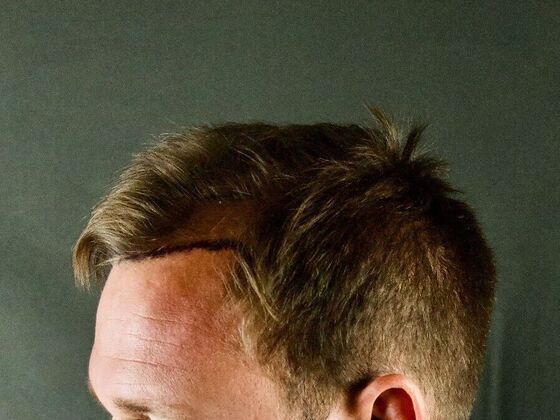 FUE Hair Restoration: Case 23 - Before