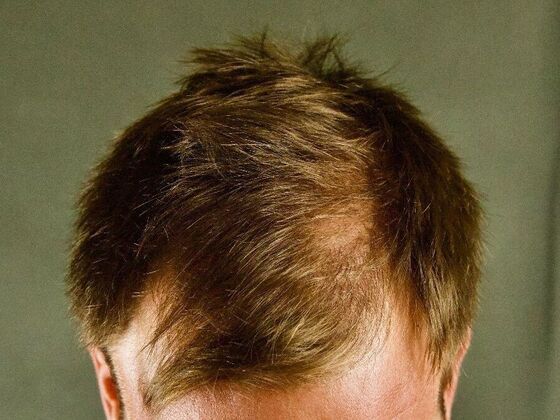 FUE Hair Restoration: Case 23 - Before