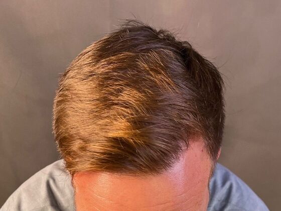 FUE Hair Restoration: Case 23 - After