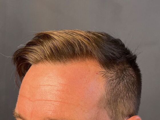 FUE Hair Restoration: Case 23 - After