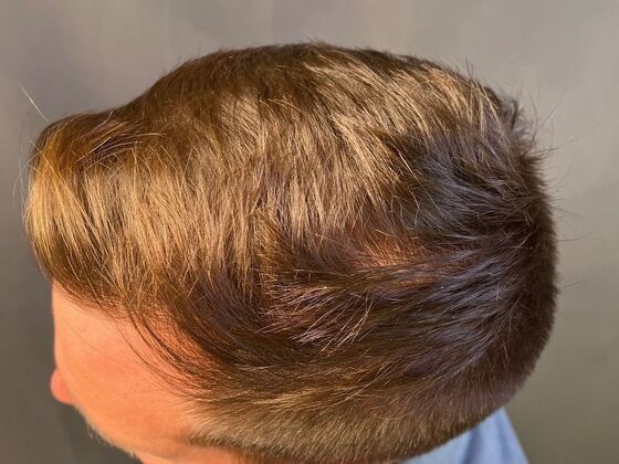 FUE Hair Restoration: Case 23 - After