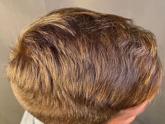 FUE Hair Restoration: Case 23 - After