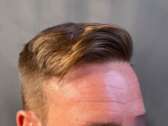 FUE Hair Restoration: Case 23 - After