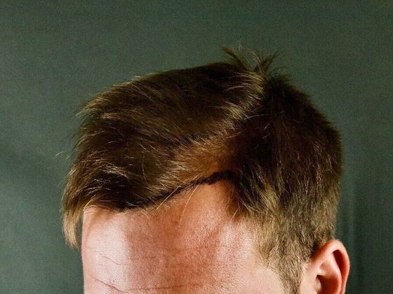 FUE Hair Restoration: Case 23 - Before