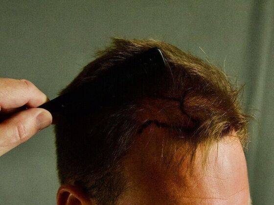 FUE Hair Restoration: Case 23 - Before