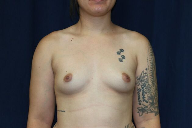 Breast Augmentation*: Case 77 - Before