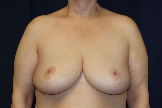 Breast Reduction*: Case 1 - After