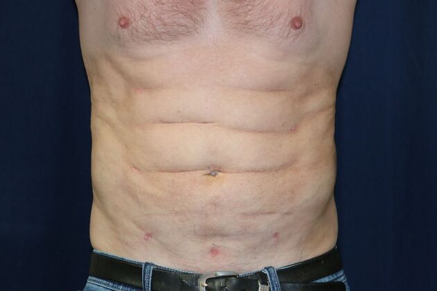 Abdominal Etching : Case 3 - After