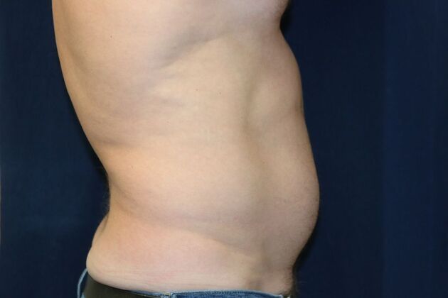 Abdominal Etching : Case 3 - Before