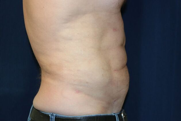 Abdominal Etching : Case 3 - After