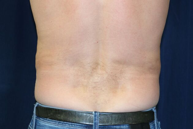 Abdominal Etching : Case 3 - After