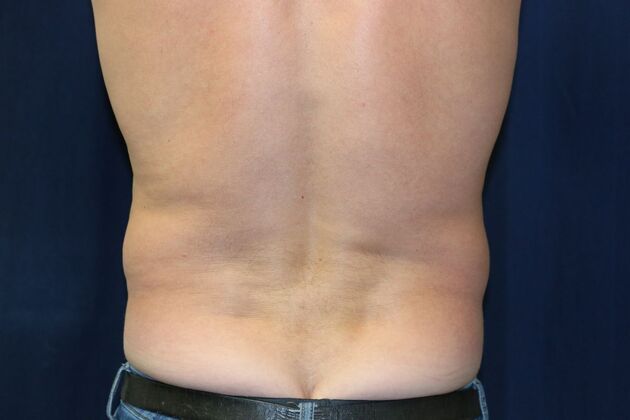 Abdominal Etching : Case 3 - Before